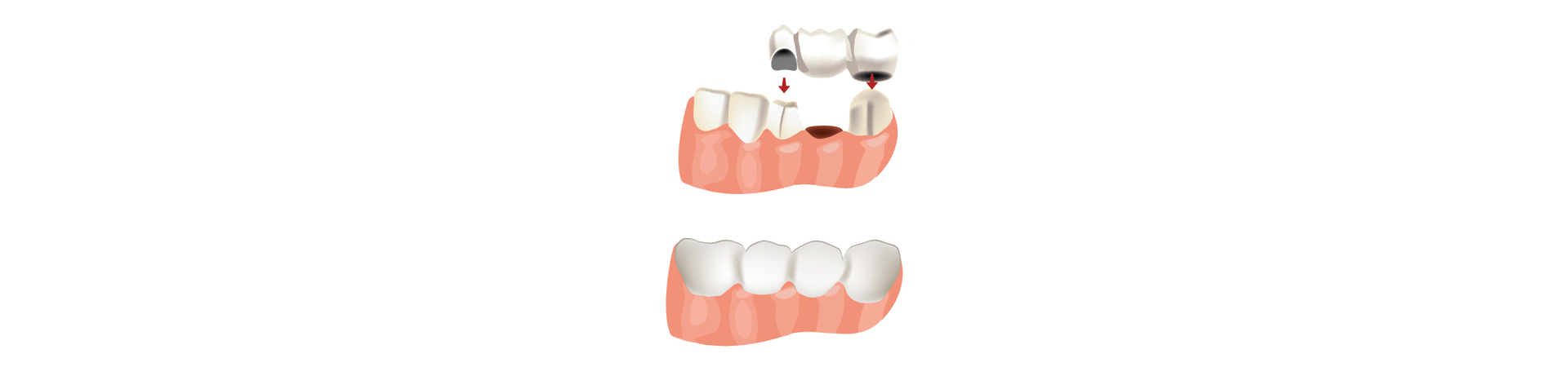 Dental Bridges Explanation