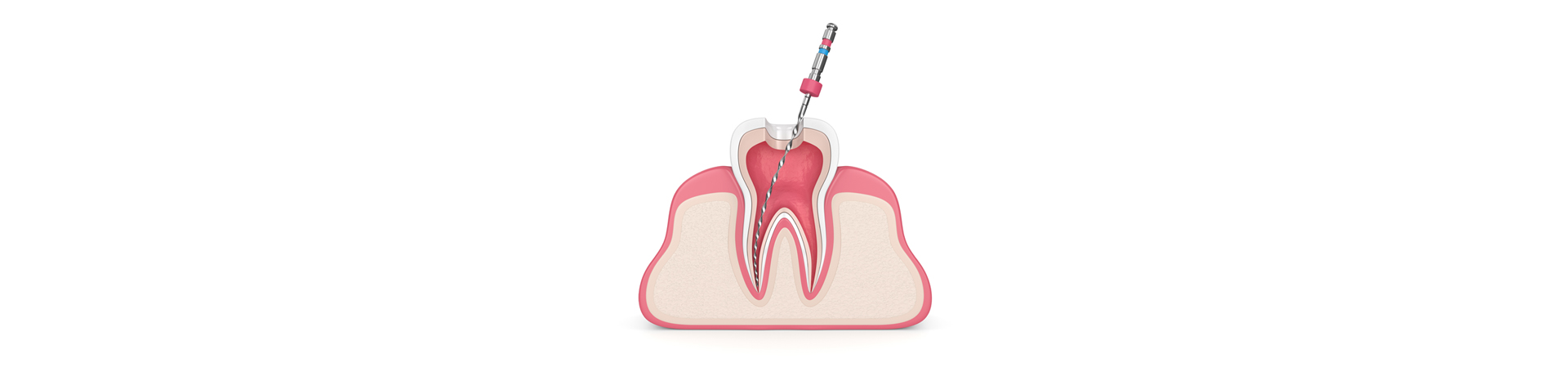 Root Canal Therapy Explanation