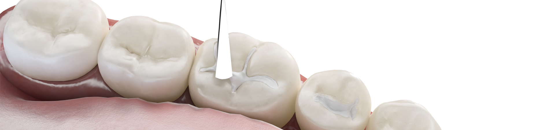 Dental Sealants Explanation