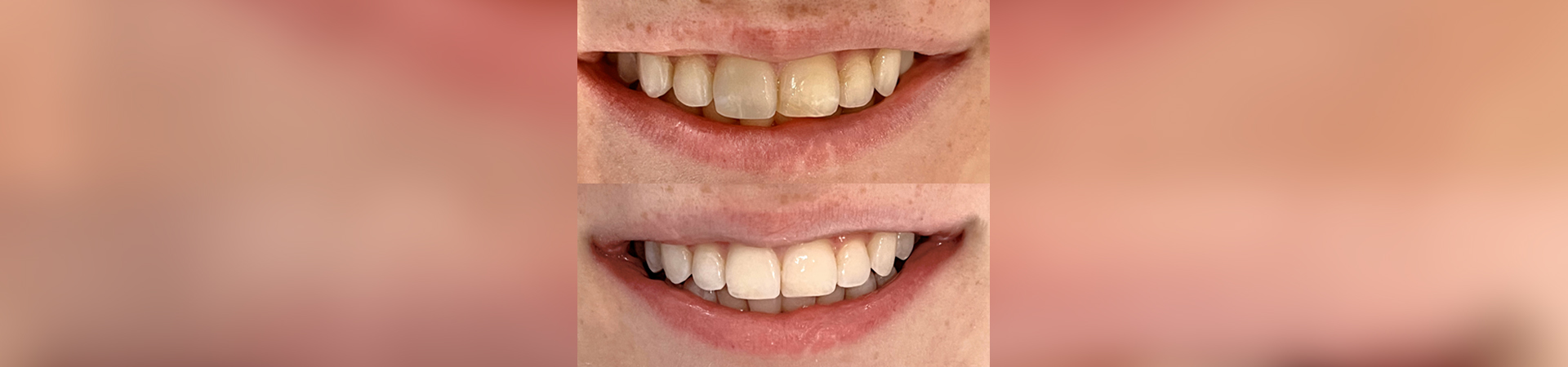 Enamel Discoloration Treatment Before & After Smile
