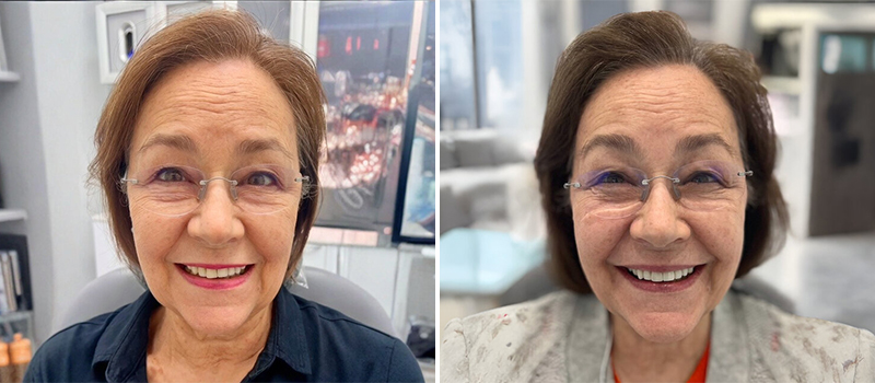 Before/After
