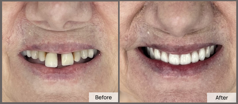 Before After_Dorothy Taylor_2